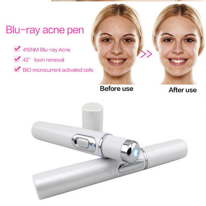 Blue Light Therapy Acne Treatment